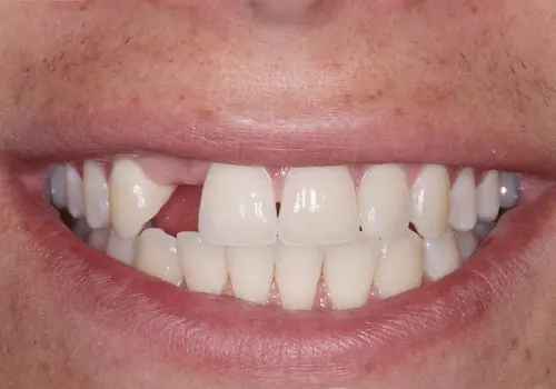 Before dental implant: a missing upper front tooth