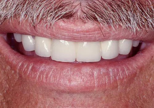 After: Bridges, Porcelain Crowns