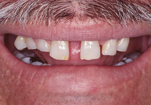 Before: Bridges, Porcelain Crowns