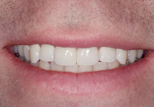 After: Dental Bonding