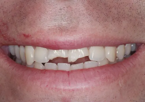 Before: Dental Bonding