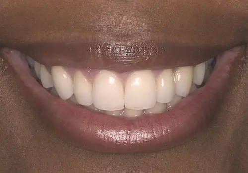 After: Gum Lift, Porcelain Crowns, Teeth Whitening