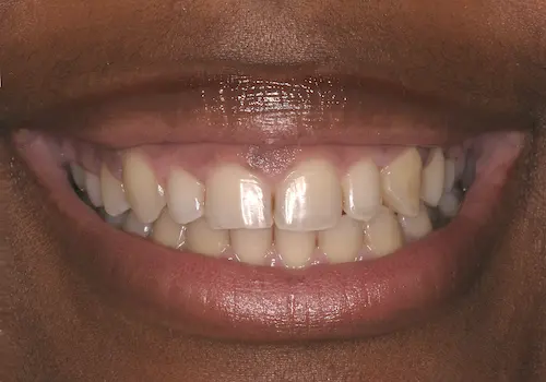 Before: Gum Lift, Porcelain Crowns, Teeth Whitening