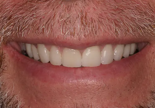 After: Gum Lift, Porcelain Crowns