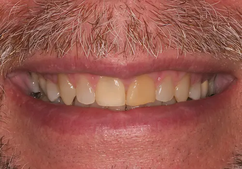Before: Gum Lift, Porcelain Crowns