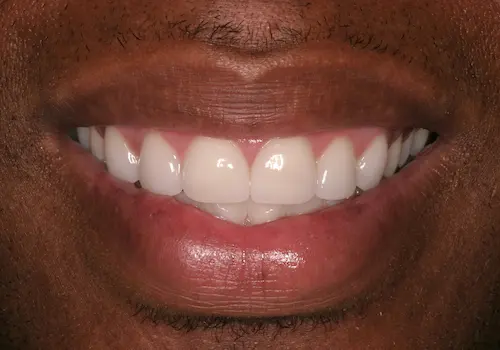 After: Dental Bonding, Porcelain Veneers