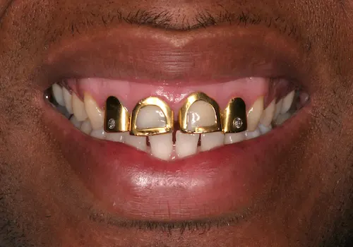 Before: Dental Bonding, Porcelain Veneers