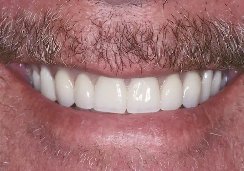 After: Dentures