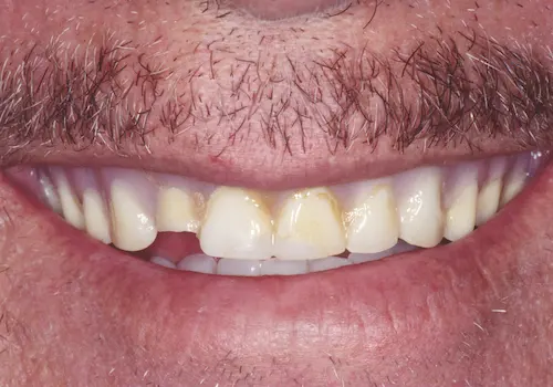 Before: Dentures