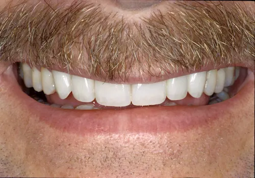 After: Porcelain Crowns