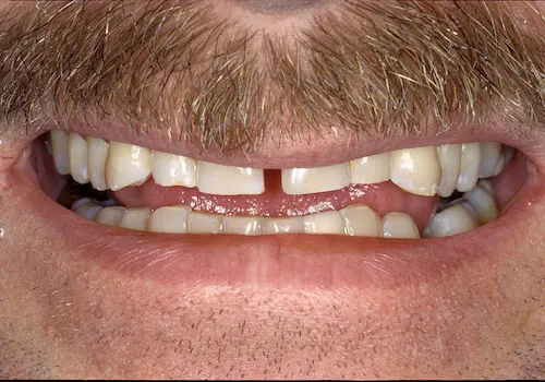 Before: Porcelain Crowns