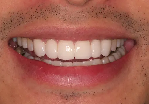 After: Dental Bonding, Porcelain Veneers, Teeth Whitening
