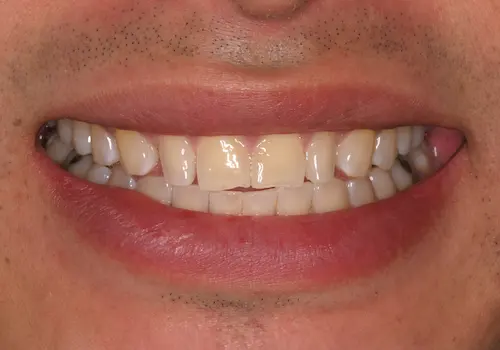 Before: Dental Bonding, Porcelain Veneers, Teeth Whitening