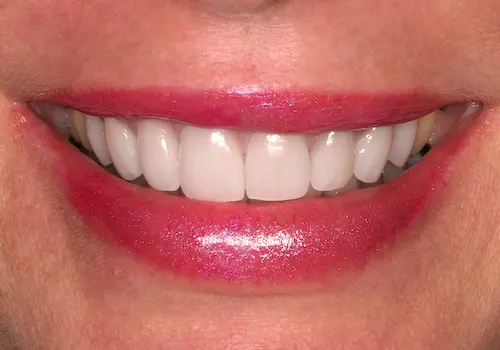 After: Porcelain Crowns