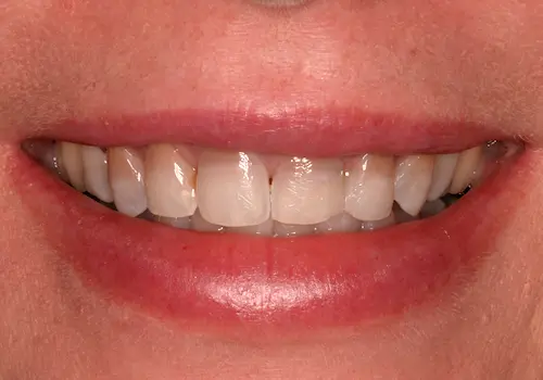Before: Porcelain Crowns