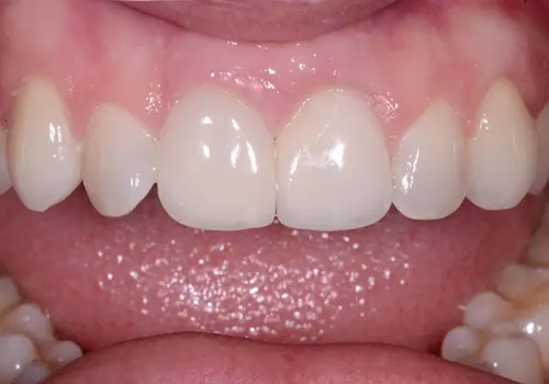 After: Implant, Porcelain Crowns, Teeth Whitening