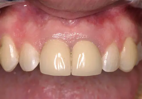 Before: Implant, Porcelain Crowns, Teeth Whitening