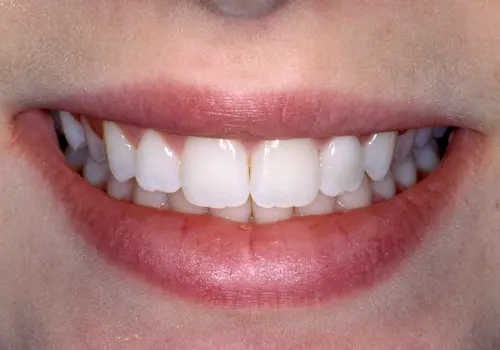 After: Gum Lift, Porcelain Crowns, Teeth Whitening