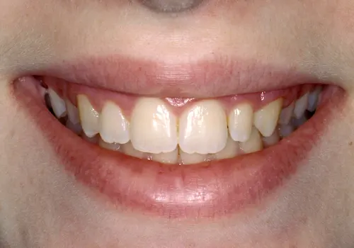 Before: Gum Lift, Porcelain Crowns, Teeth Whitening