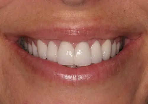 After: Gum Lift, Porcelain Veneers