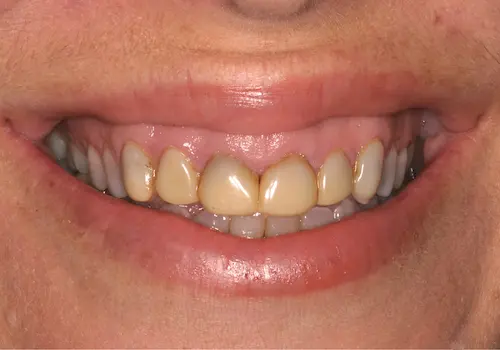 Before: Gum Lift, Porcelain Veneers