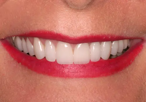 After: Gum Lift, Porcelain Crowns