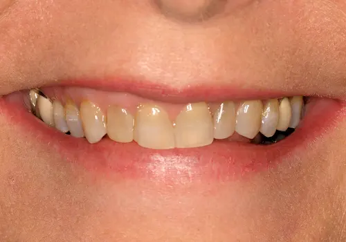 Before: Gum Lift, Porcelain Crowns