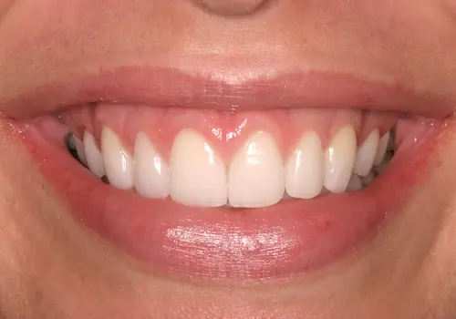 After: Gum Lift, Porcelain Veneers