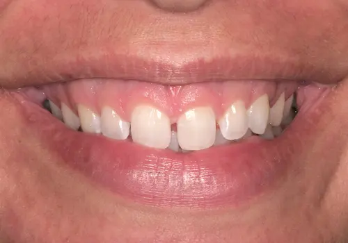 Before: Gum Lift, Porcelain Veneers