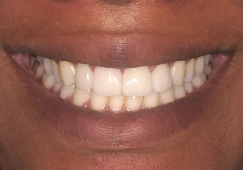 After: Gum Lift, Porcelain Veneers, Teeth Whitening
