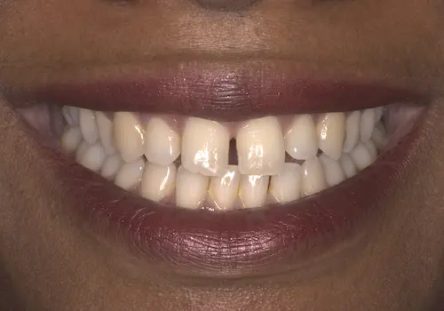 Before: Gum Lift, Porcelain Veneers, Teeth Whitening