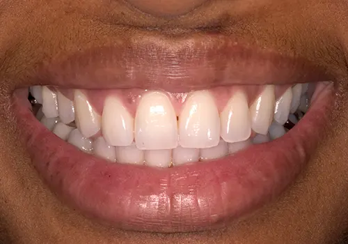After: Gum Lift, Porcelain Crowns, Teeth Whitening