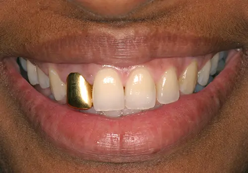 Before: Gum Lift, Porcelain Crowns, Teeth Whitening